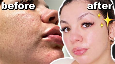 How To Get Rid Of Dry And Textured Skin Skincare Routine Youtube