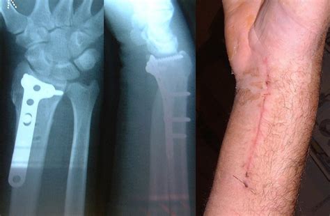 Broken Radius Recovery Time Singletrack Magazine Forum