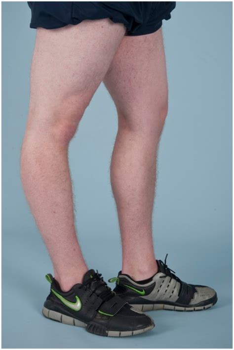 Knee Hyperextension Genu Recurvatum In A Male Patient Open I