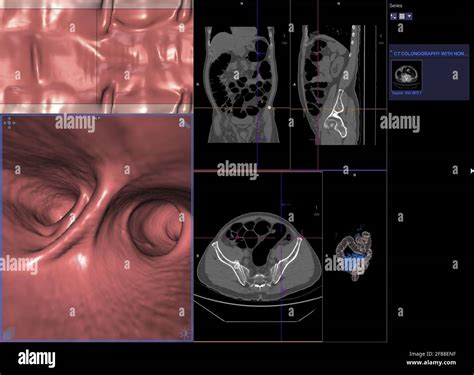 Ct Colonography Ou Ct Scan Of Colon Axial View Vs Coronal View Et 3d