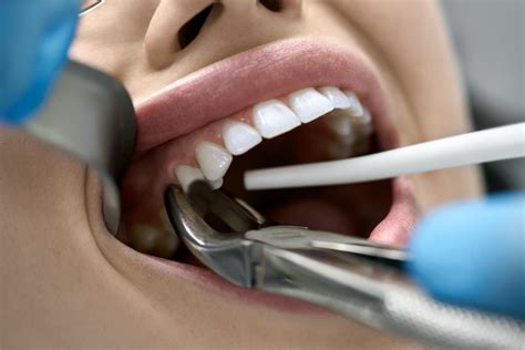 How Can I Fixed A Chipped Tooth Tysons Dental Spa