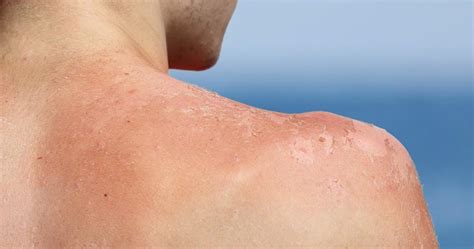 How To Get Rid Of Peeling Skin—steps To Take After Sunburn And Tiege Hanley