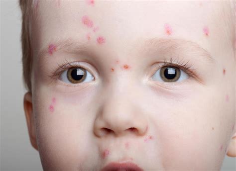 Chicken Pox Symptoms On Face Bmp Tomfoolery