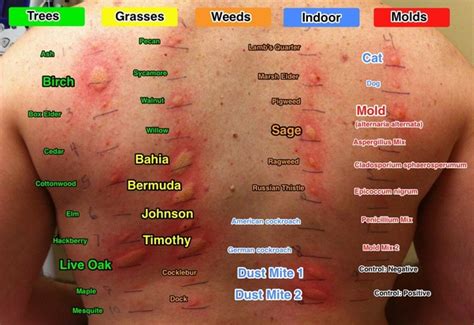 Skin Allergy Test Images Update Berita Olahraga Dalam Luar