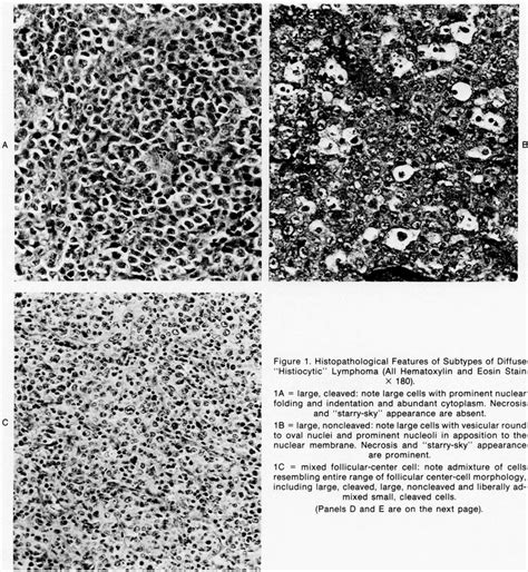 Clinical Relevance Of The Histopathological Subclassification Of