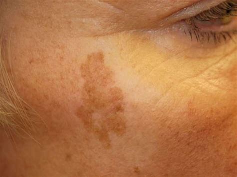Light Colored Dry Spots On Skin