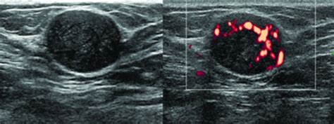 Mimickers Of Breast Malignancy On Breast Sonography Cho 2013
