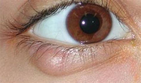 Swollen Eyelid Home Remedies Cure Upper And Lower Swollen Eyelids