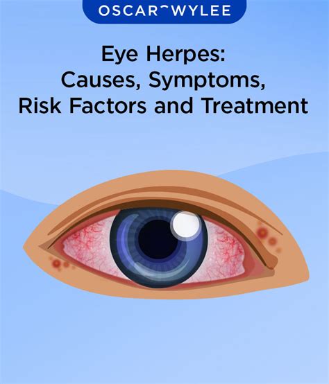 Eye Herpes Causes Symptoms Risk Factor And Treatment
