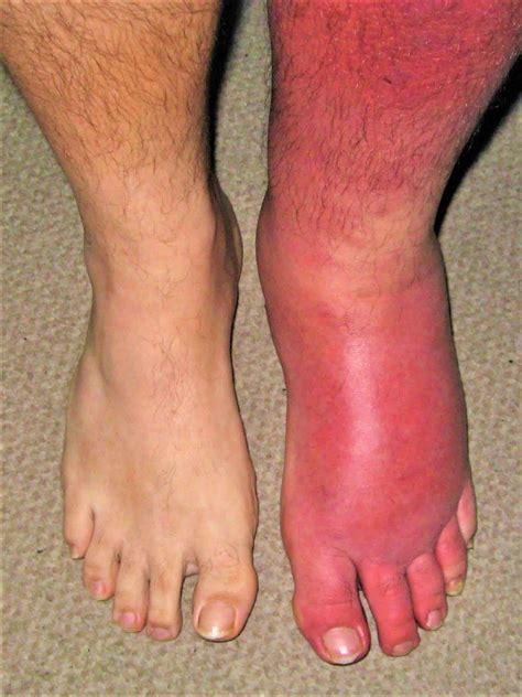 Bacterial Cellulitis Of The Leg