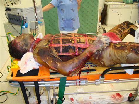 Escharotomy allows the cutaneous envelope to become more compliant. Deformutilation: The Escharotomy