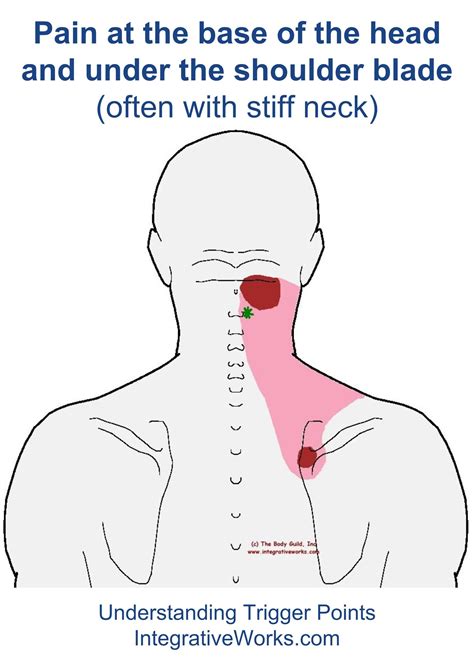 Understanding Trigger Points Pain At The Base Of The Head And Under
