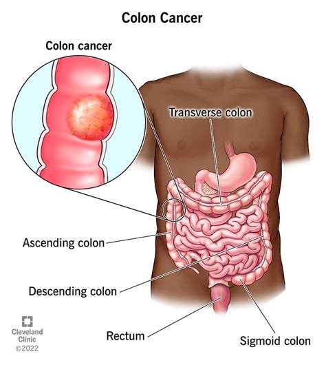 Colon Cancer Symptoms Stages And Treatment