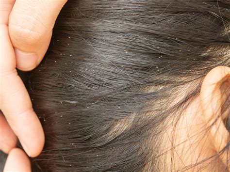 5 Best Way To Remove Nits From Hair Permanently At Home