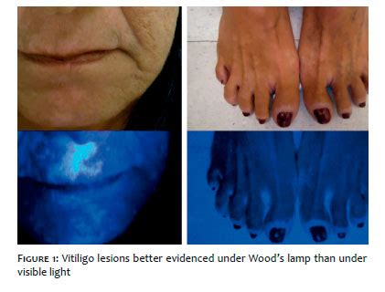 Surgical Cosmetic Dermatology Woods Lamp In Dermatology