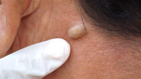 Discovernet Sebaceous Cysts The Complete Guide