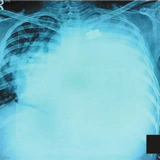 Chest X Ray Postero Anterior View Shows Completely Opaque Left