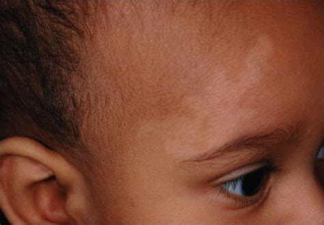 What About This Light Colored Patch Over An Infants Brow Rules Out