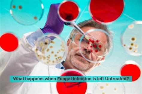 What Happens When Fungal Infection Is Left Untreated