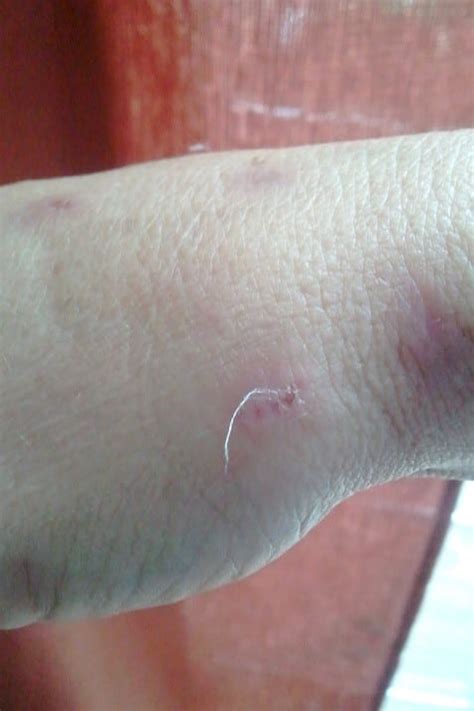 What is Morgellons Disease | The Charles E. Holman Foundation