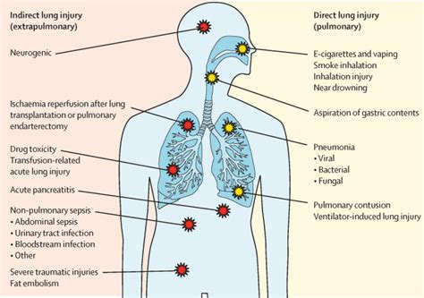 Acute Respiratory Distress Syndrome Causes Pathophysiology And