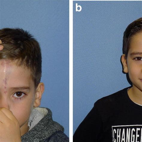 Postoperative Evolution Frontal View A 4 Years Post Surgery No Signs