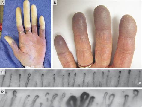 Read about treatment, causes, and diagnosis, plus. Raynaud's Phenomenon | NEJM Resident 360