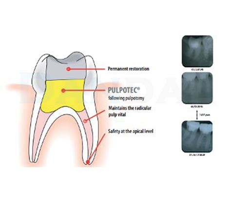 Used in reversible inflammation of pulp of. PD - Pulpotec - Dandal