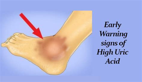 High Uric Acid Symptoms What Causes High Uric Acid Levels In The Body