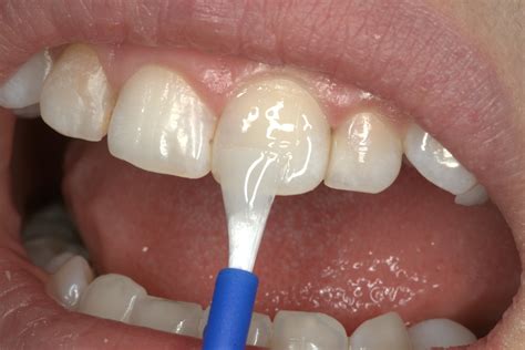In Office Fluoride Varnish Application Clinical Recommendations