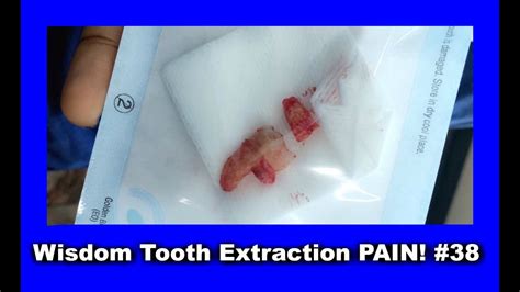 Wisdom Tooth Extraction Pain 38 Youtube