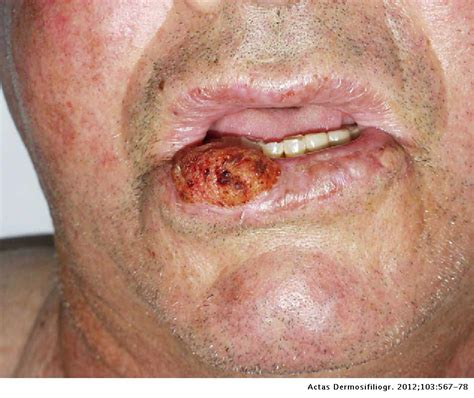 What Does Squamous Cell Cancer Of The Lip Look Like Squamous Cell