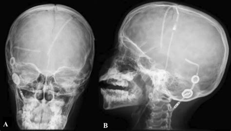 Skull X Ray Showing Two Ventriculoperitoneal Shunt Systems AP And