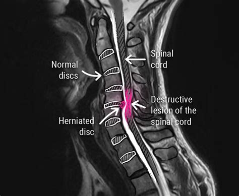 Intervertebral Disc Prolapse Xray