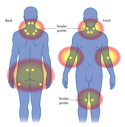 In this video i will explain what we know about fibromyalgia. Fibromyalgia: what is it? | Diagnosis | Treatment ...