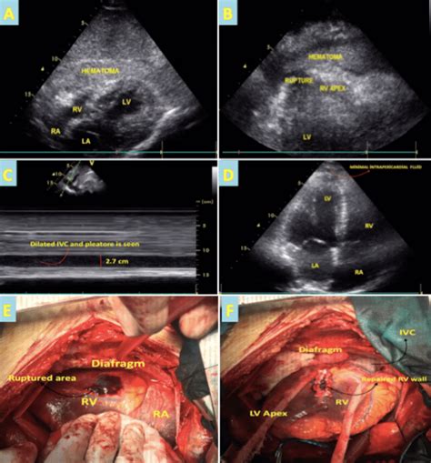 A Transthoracic Echocardiogram Subcostal View Shows An Extensive