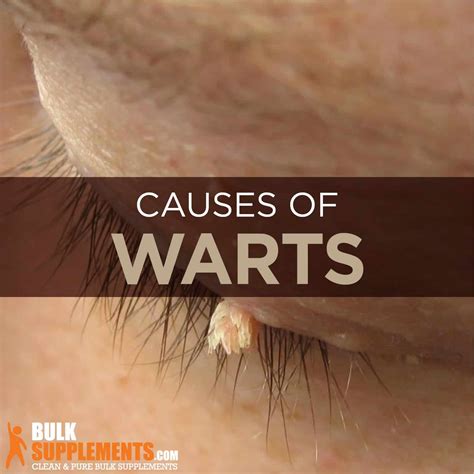 Warts Causes Symptoms Characteristics And Treatment