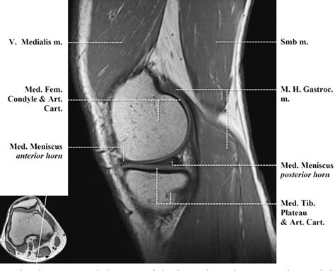 Knee Muscle Anatomy Axial Mri Figure From Normal Mr Imaging Anatomy