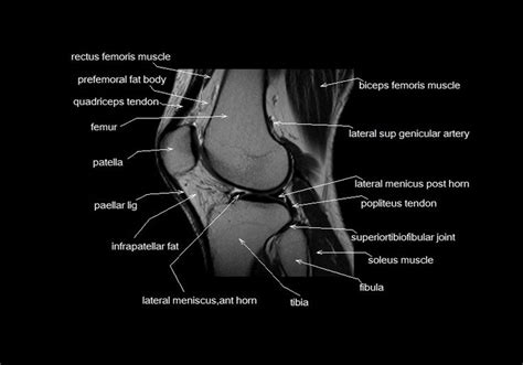 Mri Knee Cross Sectional Anatomy Sagittal Image 6 Mri Knee Mri