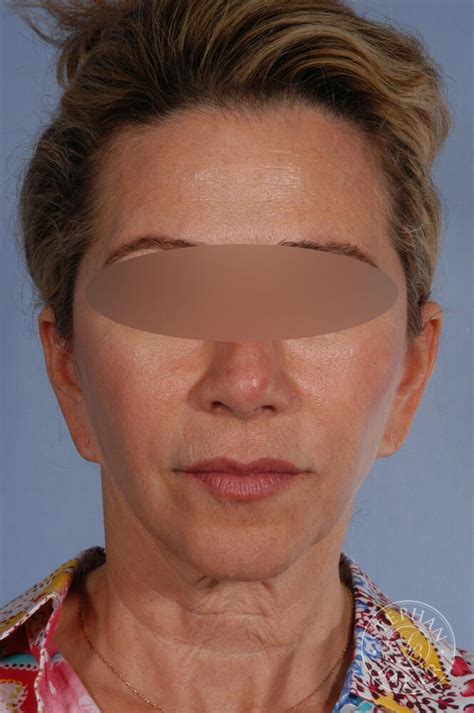 Face And Neck Lift Before And After Patient 09 Stephan Baker Md Facs