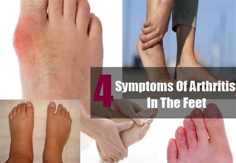 Arthritis In Feet And Toes Symptoms Sigila Mencurah Pedih