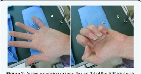 Dynamic External Fixation For Unstable Fracture Dislocations And Pilon