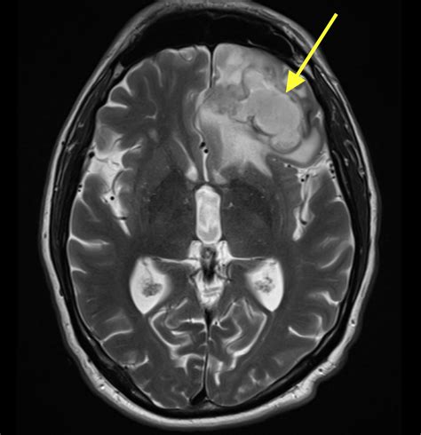 Frontal Lobe Abscess As A Result Of Remote Penetrating Trauma Eurorad