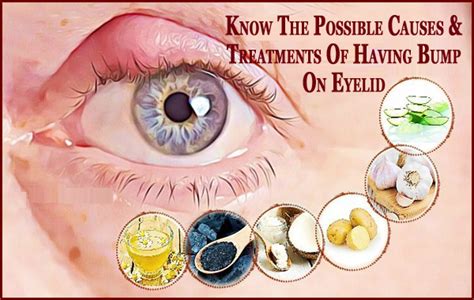 Know The Possible Causes And Treatments Of Having Bump On Eyelid