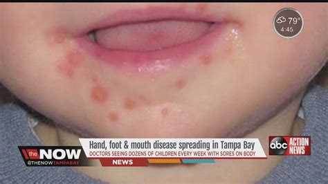 Hand Foot And Mouth Disease Spreading In Tampa Bay Area Youtube