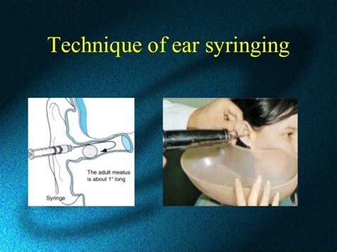 Ear Wax And Syringing