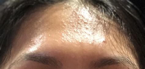 Skin Concerns What Can I Do About My Forehead Ive Has This Type Of
