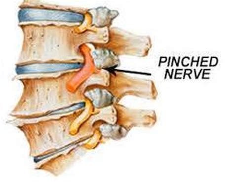 Pinched Nerves Scharenberg Chiropractic Offices