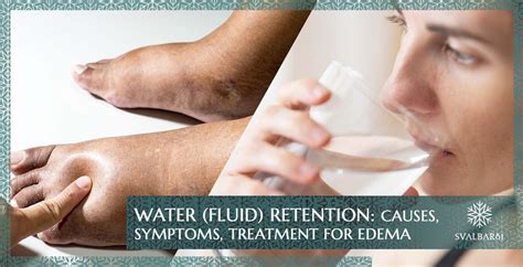 Water Fluid Retention Causes Symptoms Treatment For Edema