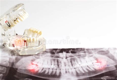 Impacted Wisdom Teeth On An X Ray Picture With An Inflamed Cyst